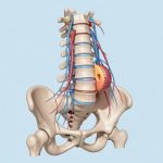 Illustration médicale réaliste d’un rachis lombaire montrant les racines nerveuses de la queue-de-cheval et une hernie discale qui les comprime.